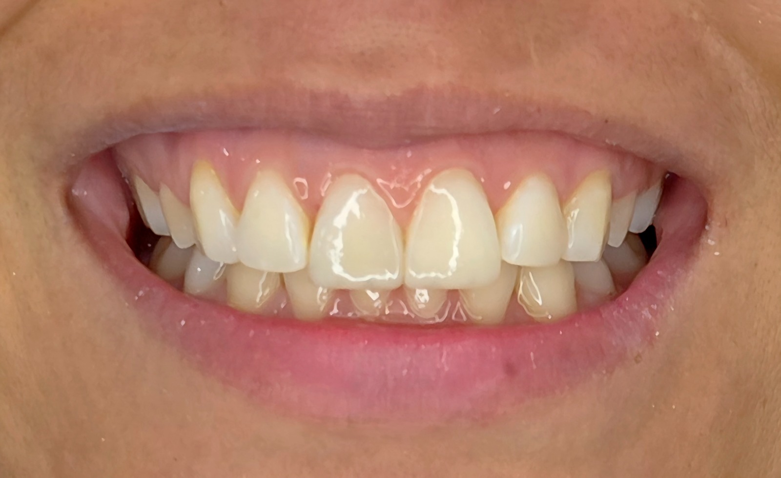 Clareamento dental — depois